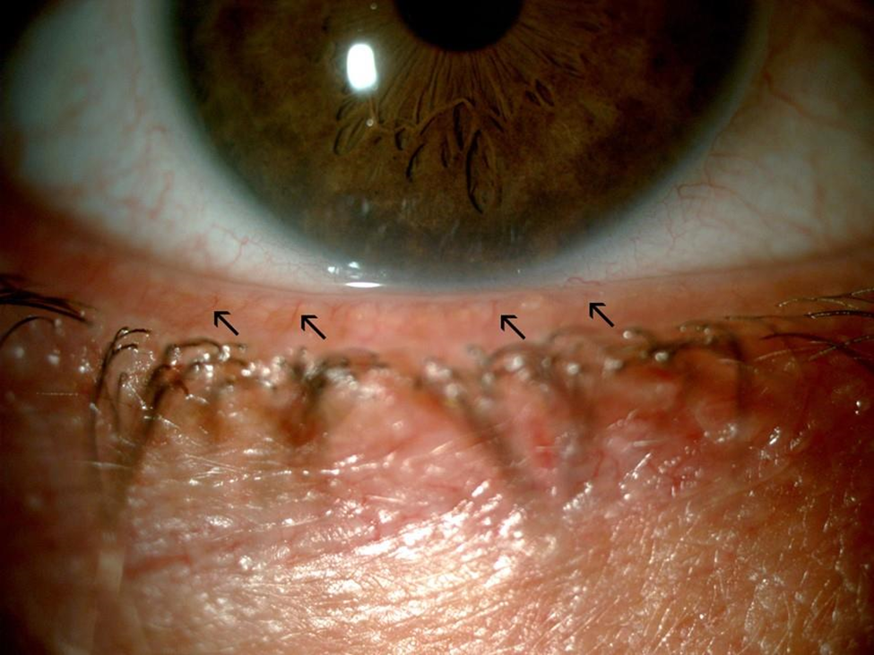 Blepharitis And Meibomian Gland Dysfunction American Association For