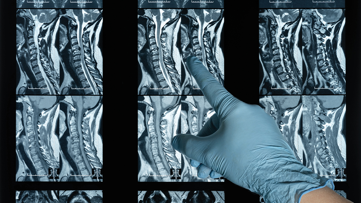  gloved hand points to one of several spinal MRI scans displayed on a lightboard.