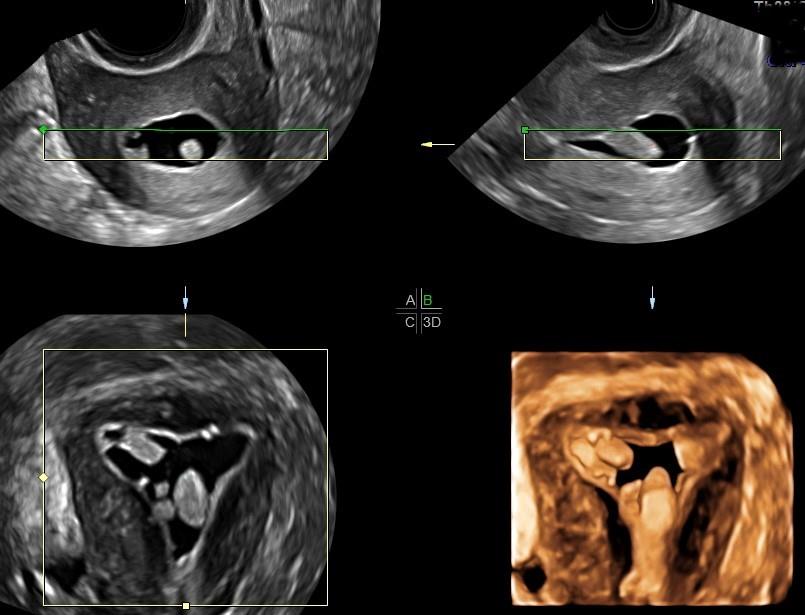 Endometrial polyps (“Hyperechoic lesions/filling defects”)