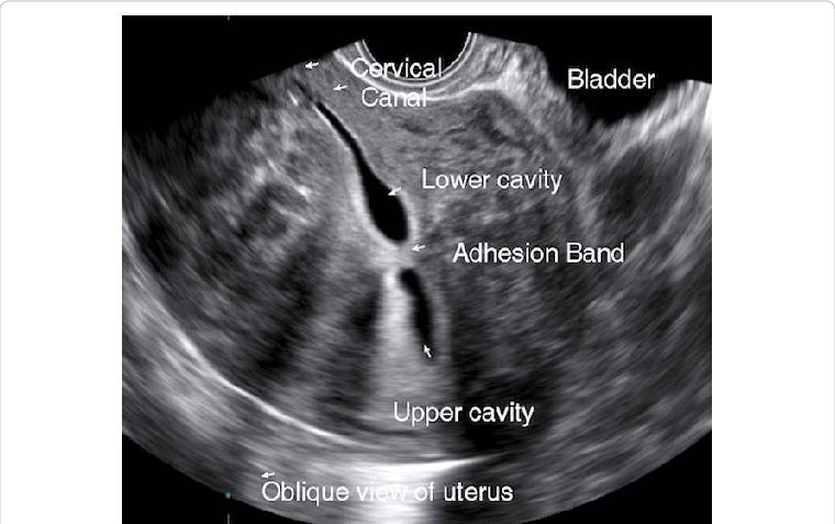 Adhesions (“hyperechoic band-like lesions”)