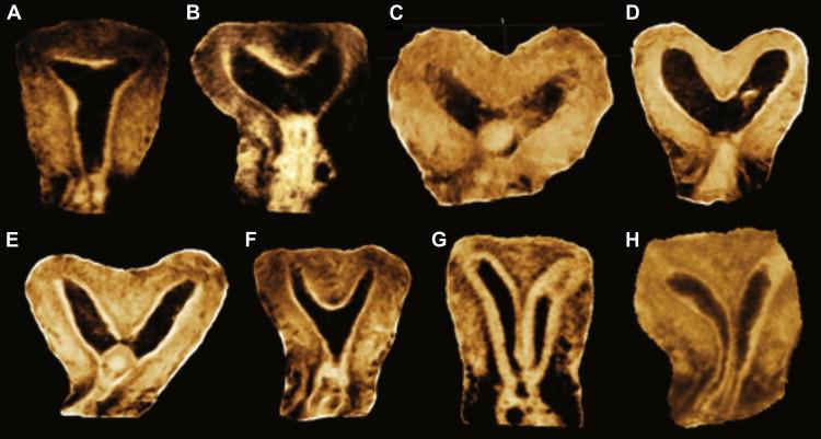 (A) Normal uterus; (B) Arcuate uterus; (C, D)Bicornuate uterus; (E, F, G) Partial septate uterus; (H) Complete septate