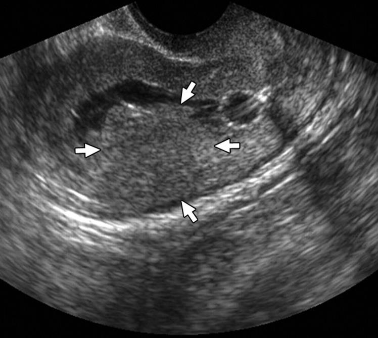 Borders of cavity are irregular with small diverticula, suggestive of adenomyosis