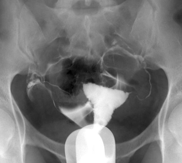 Borders of cavity are irregular with small diverticula, suggestive of adenomyosis