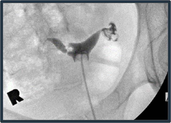 Irregular filling defect (note location), suggestive of potential adhesion