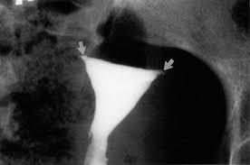 No tubal fill or spill, despite additional time and contrast. Proximal obstruction vs tubal spasm.
