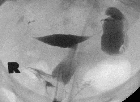 The (right/left) tube demonstrates prompt fill, with distal dilation and no spill. Appearance suggestive of hydrosalpinx.