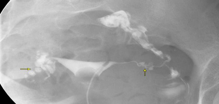 The (right/left) tube fills with small diverticular along the isthmic portion, suggestive of salpingitis isthmica nodosa (SIN).