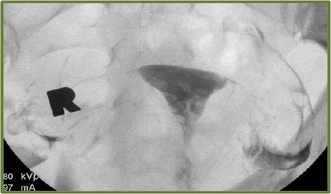 Rounded filling defect in the (location), suggestive of intrauterine polyp