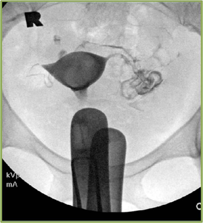 Intracavity filling defect (note size/location), and additional contrast required to distend cavity.