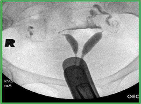 The cavity fills as two symmetric horns, suggestive of septate vs bicornuate uterus