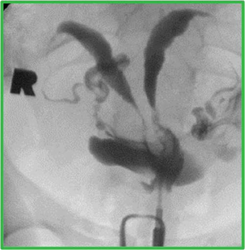The cavity fills as two distinct, closely approximated symmetric uterine horns, suggestive of septum. Cannot r/o bicornuate.
