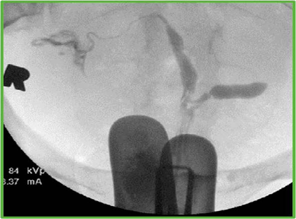 The cavity fills as two distinct, symmetric divergent uterine horns. The angle between is suggestive of a bicornuate uterus.