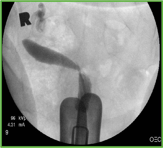 Impression: (Right/left) unicornuate, MRI may be considered to identify a non-communicating horn and to r/o a didelphys.