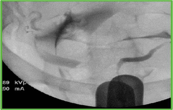 Two cervixes are recognized and cannulated for exam (document location and difficulty of identifying each cervix). HSG demonstrates two distinct, widely divergent uterine cavities, each with fallopian tube. (document fill/spill for each).