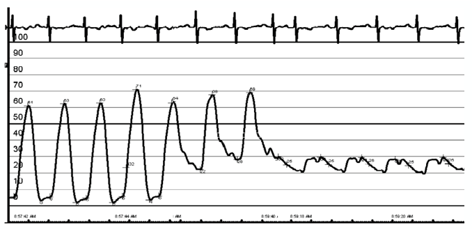 CVM Chapter_Figure 4_Schematic of PAC and Pressure Tracings as catheter travels through the heart