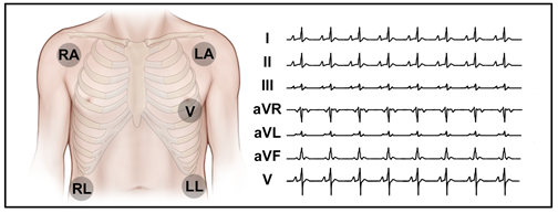 CVM Chapter_Figure 8_Typical 5-lead set up for ECG Monitoring in the ICU