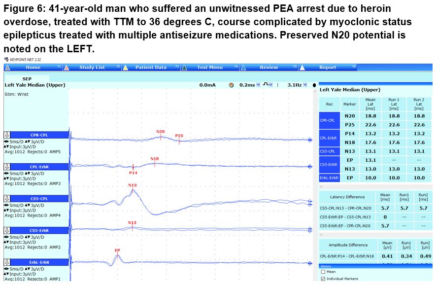 Figure 6_41 year old man who suffered an witnessed PEA arrest