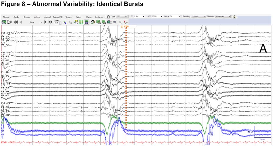 Figure 8_1_Abnormal Variability_Identical Bursts