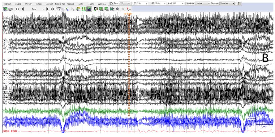 Figure 8_1_Abnormal Variability_Identical Bursts