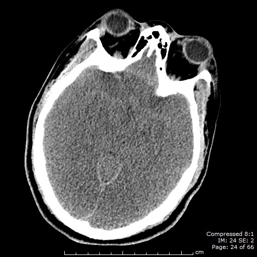 Figure 9_CT in cardiac arrest