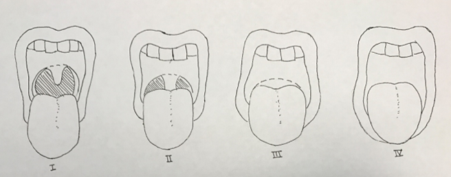 Respiratory Chapter_Figure 1_Mallampati Classification