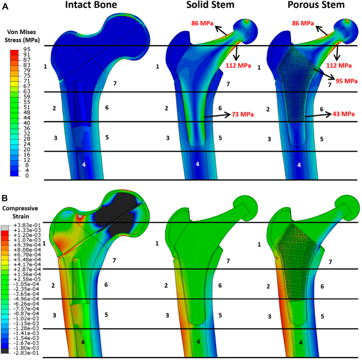 How to Design a Graded Hybrid Porous Hip Implant Stem to Reduce Stress