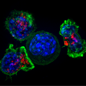 Genetic_risk_analysis_of_a_patient_with_fulminant_autoimmune_type_1_diabetes_mellitus.jpg