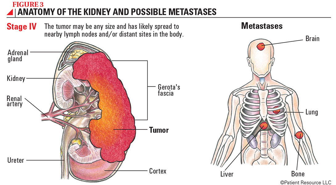 Kidney (Renal) Cancer - Society for Immunotherapy of ...