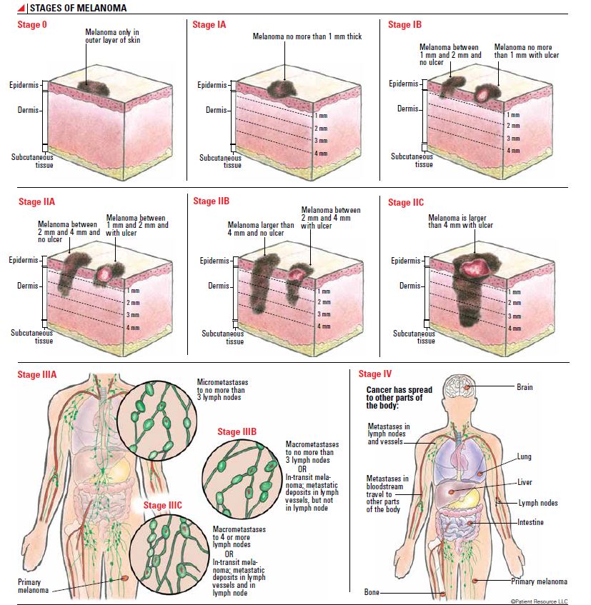 Melanoma Stages Chart M lanome Cancer TFSGHK