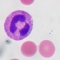 Genetic_risk_analysis_of_a_patient_with_fulminant_autoimmune_type_1_diabetes_mellitus.jpg