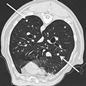 Genetic_risk_analysis_of_a_patient_with_fulminant_autoimmune_type_1_diabetes_mellitus.jpg