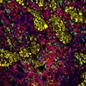 Genetic_risk_analysis_of_a_patient_with_fulminant_autoimmune_type_1_diabetes_mellitus.jpg