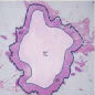 Differential_intratumoral_distributions.jpg