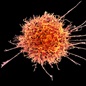 Genetic_risk_analysis_of_a_patient_with_fulminant_autoimmune_type_1_diabetes_mellitus.jpg