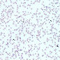 Genetic_risk_analysis_of_a_patient_with_fulminant_autoimmune_type_1_diabetes_mellitus.jpg