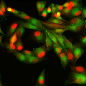 Genetic_risk_analysis_of_a_patient_with_fulminant_autoimmune_type_1_diabetes_mellitus.jpg