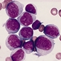 Genetic_risk_analysis_of_a_patient_with_fulminant_autoimmune_type_1_diabetes_mellitus.jpg