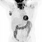Genetic_risk_analysis_of_a_patient_with_fulminant_autoimmune_type_1_diabetes_mellitus.jpg