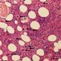 Genetic_risk_analysis_of_a_patient_with_fulminant_autoimmune_type_1_diabetes_mellitus.jpg