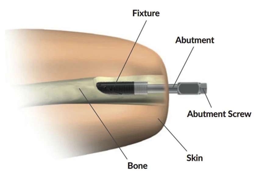 Osseointegration Statistics Show Benefits for Amputees